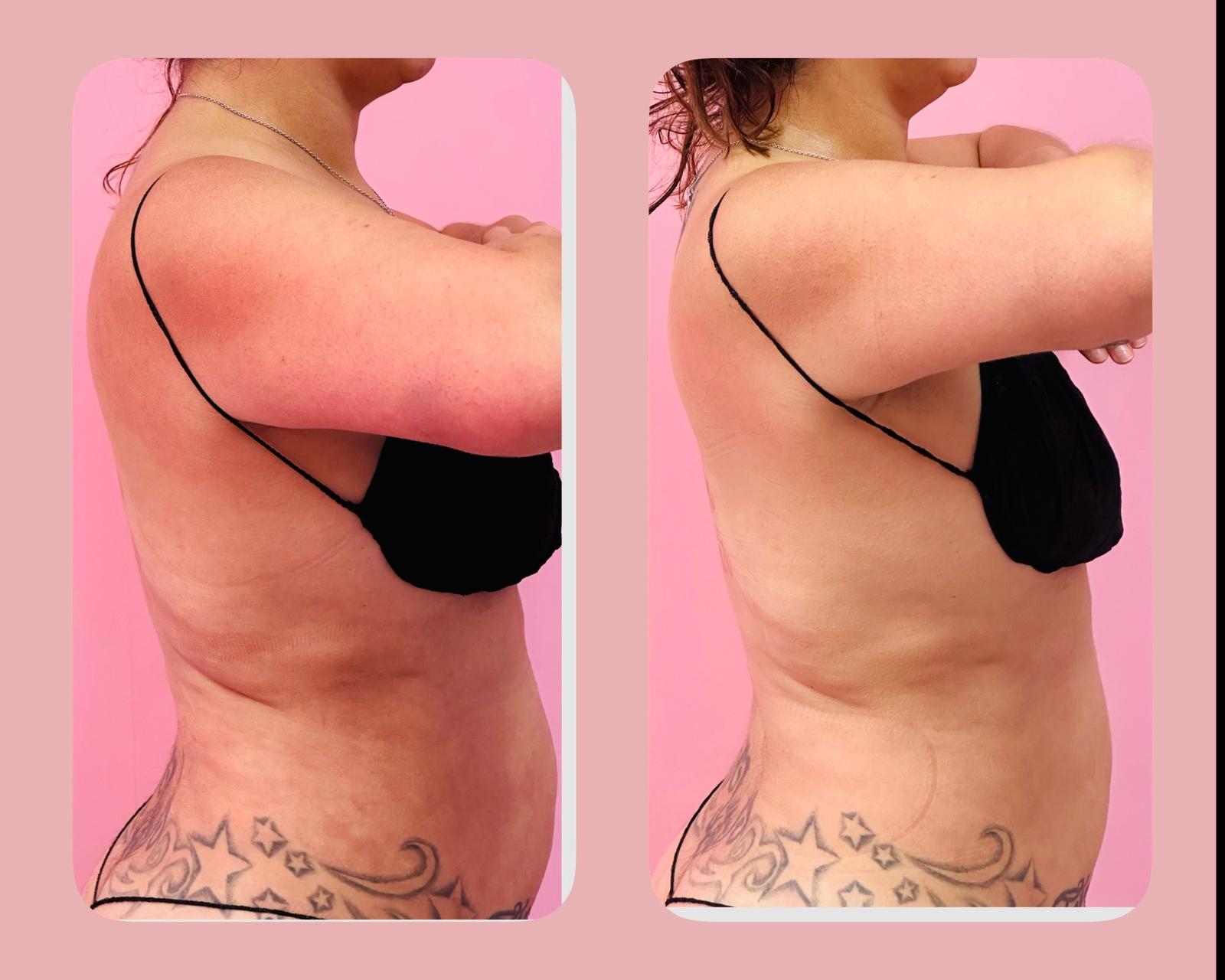 Body contouring results