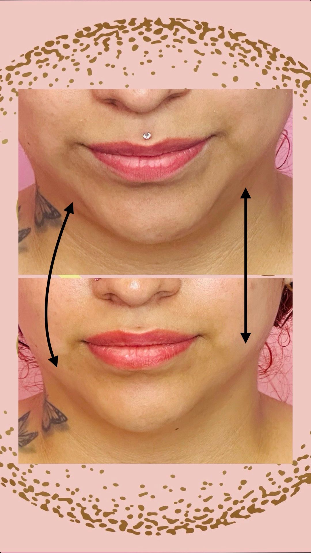 Chin reduction results