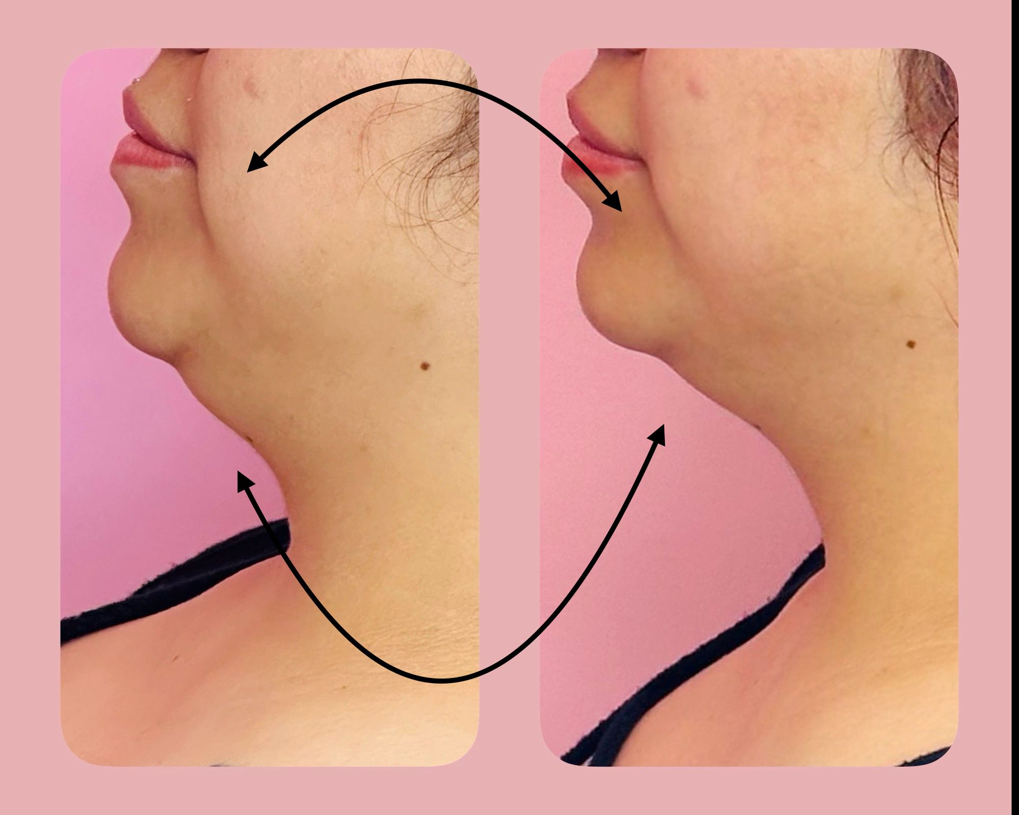 Chin reduction side-by-side